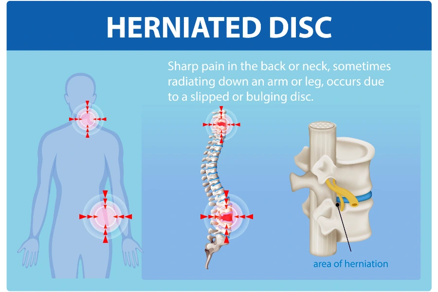 Herniated Disc: When Surgery Is Necessary — and When It Is Not