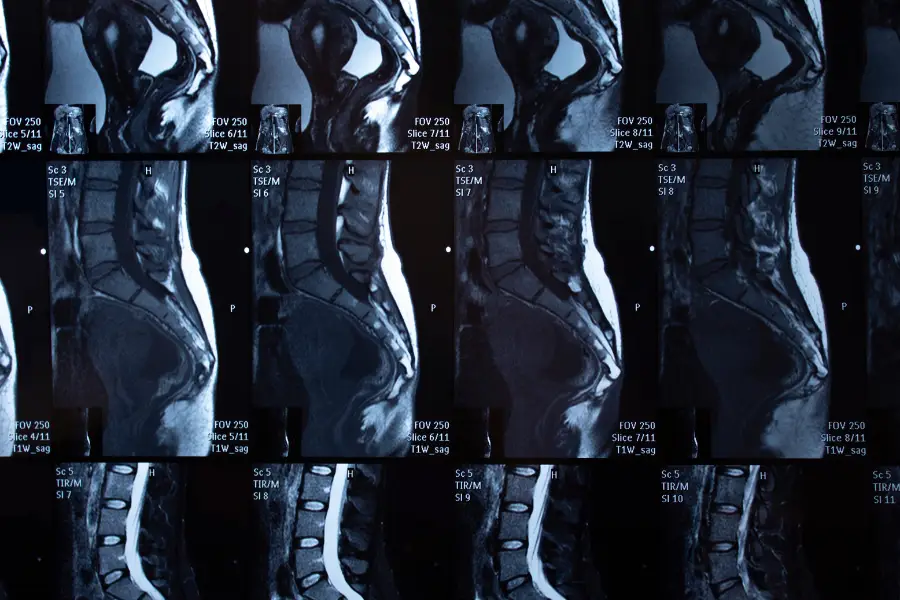 MRI and Back Pain: What Imaging Really Shows — and What It Doesn’t MRI and Back Pain: What Imaging Really Shows Natalia Skizha